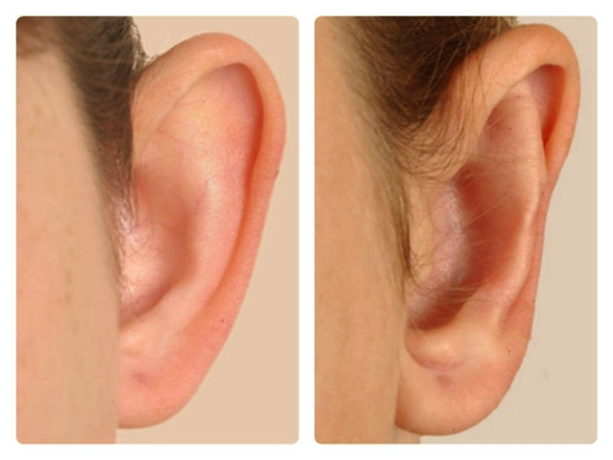2 vành tai không đều